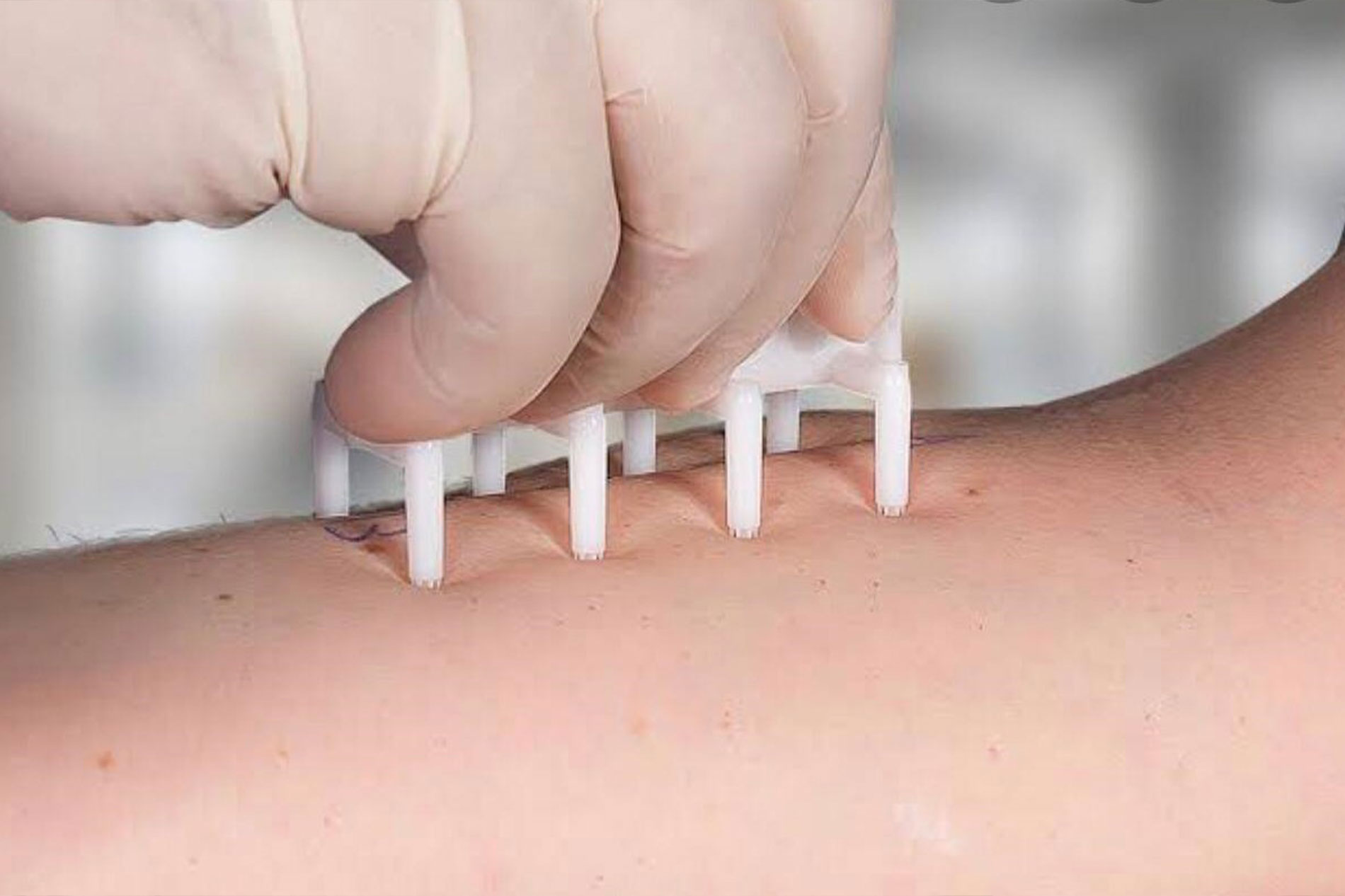 PRICK TEST TESTE ALÉRGICO Clínica de Otorrinolaringologia Clarissa Jardim